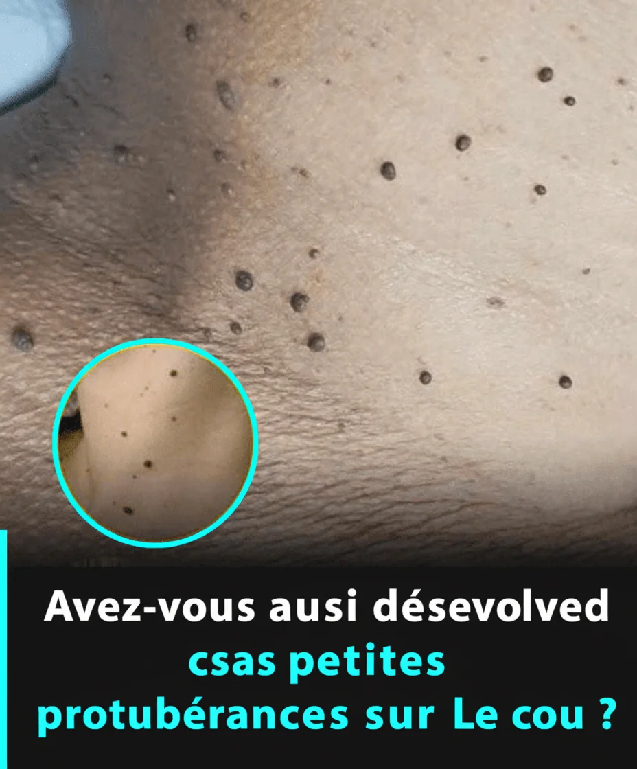 Si vous avez remarqué ces petites excroissances cutanées sur le cou ou sous les aisselles, il se pourrait que…