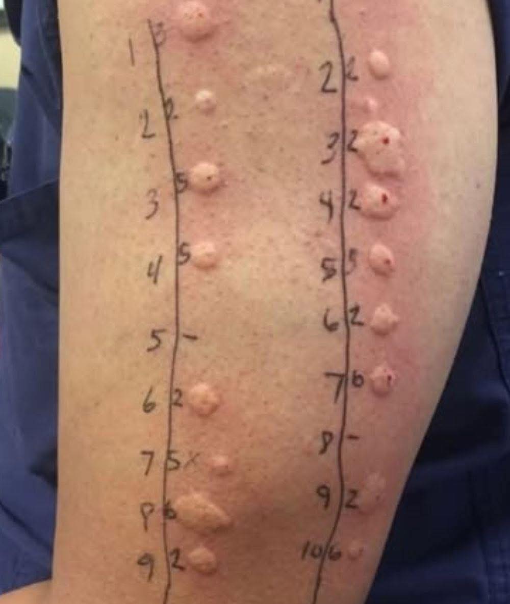 Une marque sur votre peau au réveil ? Ce que cela signifie et quand s'inquiéter