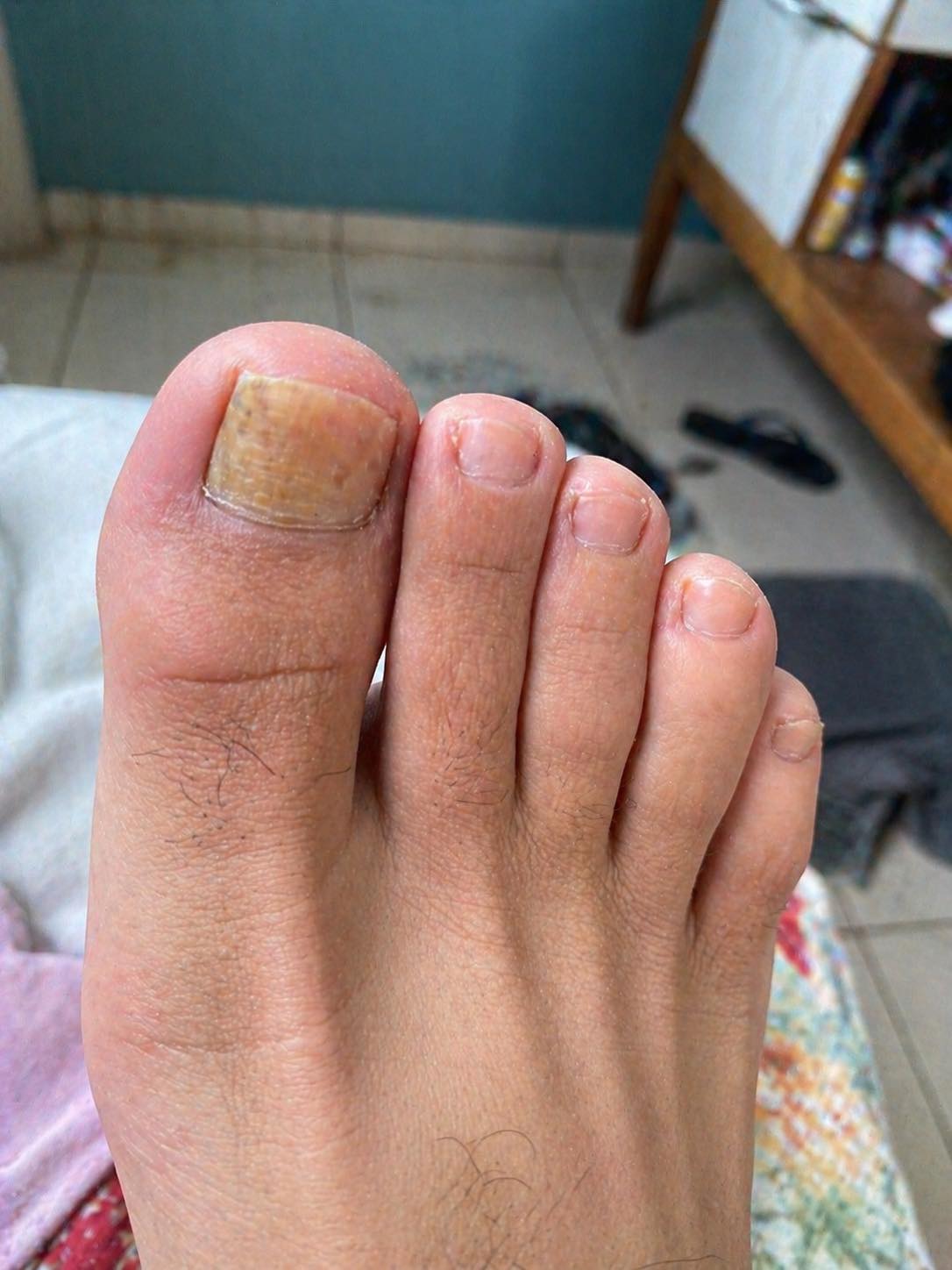 Adieu les mycoses des ongles : un remède naturel simple et efficace