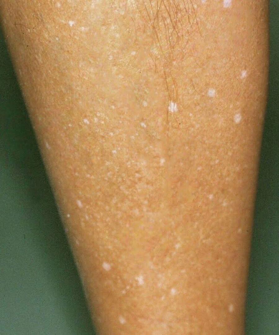 Taches blanches sur la peau : comprenez les causes possibles