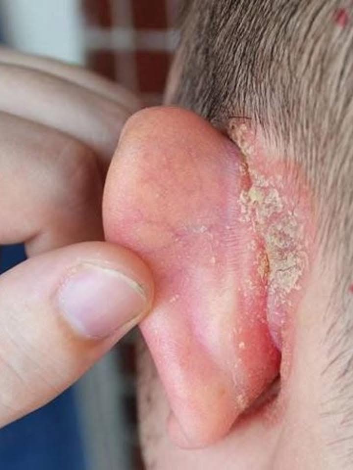 Mon enfant s'est réveillé avec une tache sur l'oreille : de quoi s'agit-il et comment en prendre soin en attendant la consultation ?