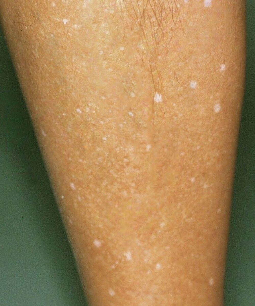 Quelles sont les causes des taches blanches sur la peau ? Découvrez les raisons possibles