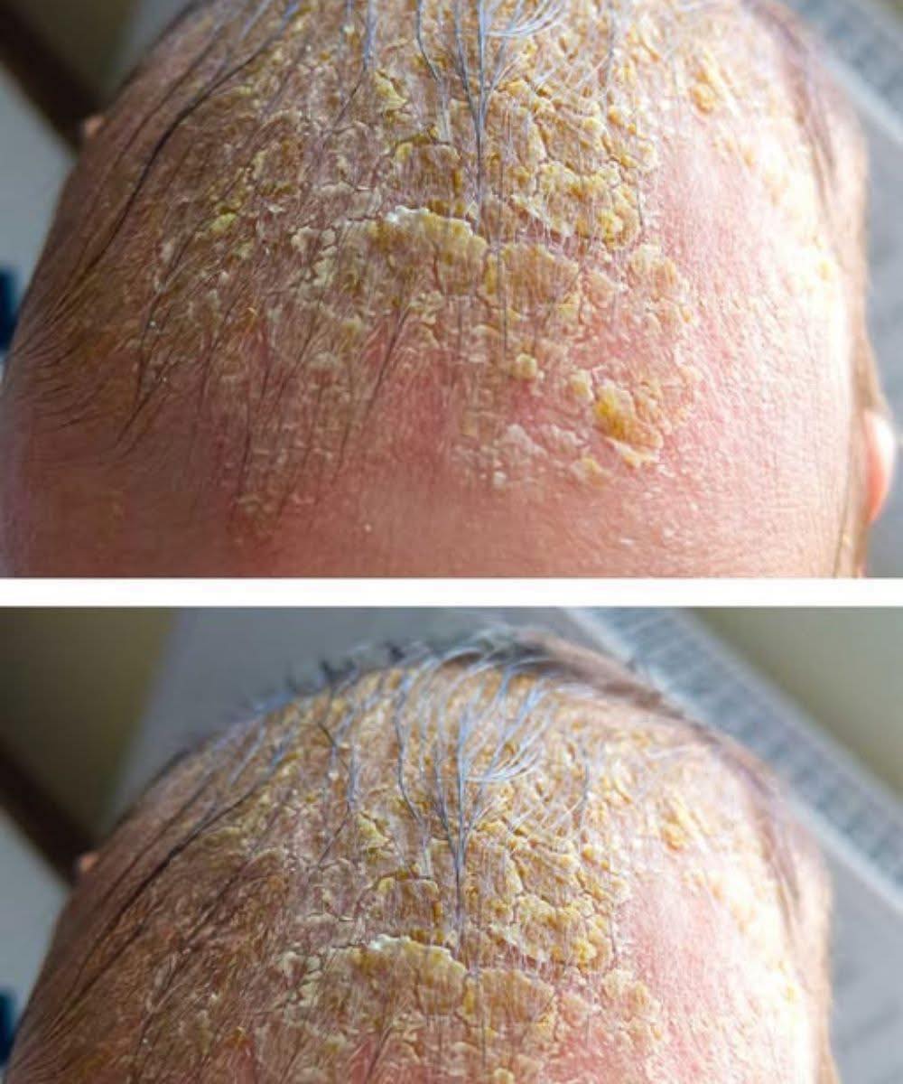 Croûte jaune avec écoulement sur le cuir chevelu : causes et quand s'inquiéter